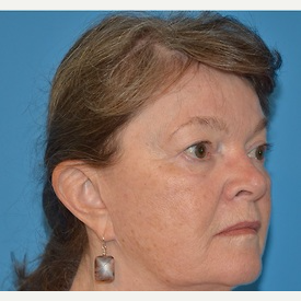 35-44 year old woman treated with Eyelid Surgery before 3065725