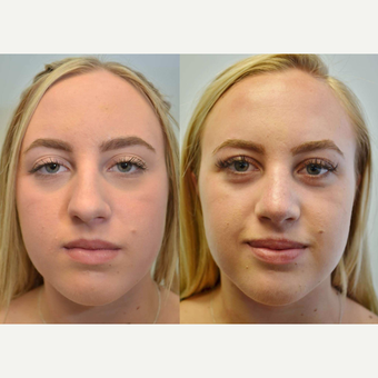 (Rhinoplasty) 17 Year Old Female with difficulty breathing, collapsed airway, and nostril asymmetry before 3076781