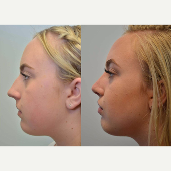 (Rhinoplasty) 17 Year Old Female with difficulty breathing, collapsed airway, and nostril asymmetry after 3076781