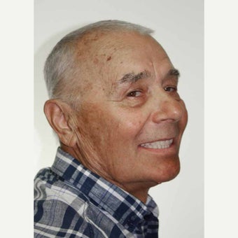 65-74 year old man treated with All-on-4 Dental Implants 1671696