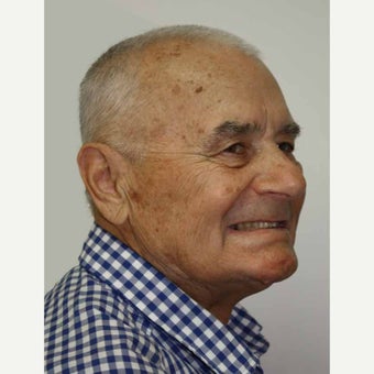 65-74 year old man treated with All-on-4 Dental Implants 1671696