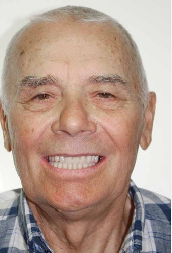 65-74 year old man treated with All-on-4 Dental Implants after 1671696