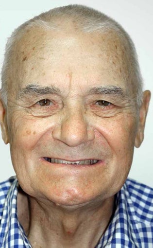 65-74 year old man treated with All-on-4 Dental Implants before 1671696
