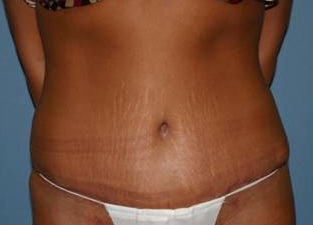 Tummy Tuck after 1021207