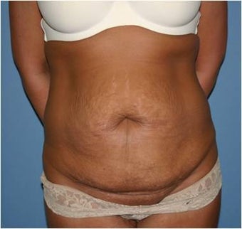 Tummy Tuck before 1021207