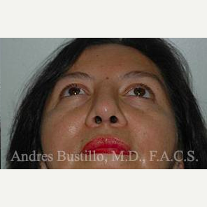 43 year old woman treated with Revision Rhinoplasty after 3460790