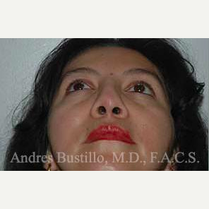 43 year old woman treated with Revision Rhinoplasty before 3460790