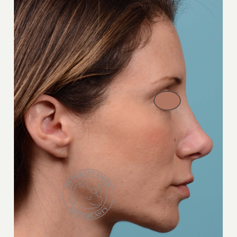 35-44 year old woman treated with Revision Rhinoplasty/Septoplasty before 3093948