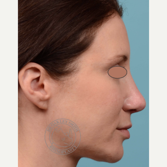 35-44 year old woman treated with Revision Rhinoplasty/Septoplasty after 3093948