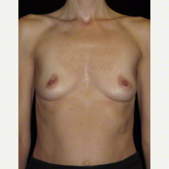 40 year old woman treated with Breast Augmentation before 3103659