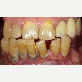 55-64 year old woman treated with All-on-4 Dental Implants before 3113898