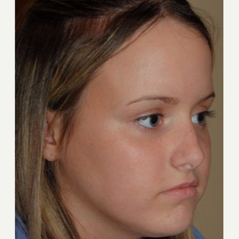 17 or under year old woman treated with Rhinoplasty before 3711437
