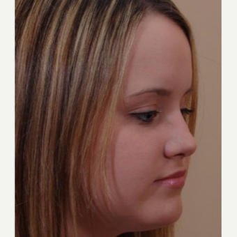 17 or under year old woman treated with Rhinoplasty after 3711437