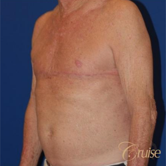 64 year old man treated with male breast reduction surgery after 3196814