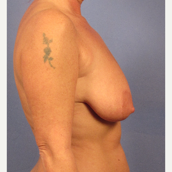 45-54 year old woman treated with Breast Lift before 3095886