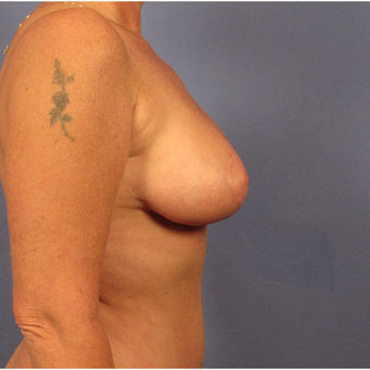 45-54 year old woman treated with Breast Lift after 3095886