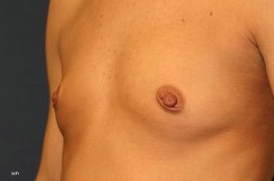 35-44 year old woman treated with Breast Augmentation before 1661725