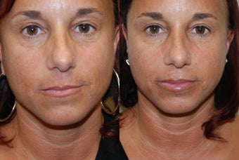 Silikon-1000 for lips, nasolabial wrinkles, and "bar code". Xeomin crow's feet. before 1442654