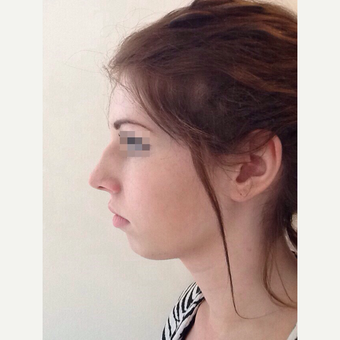 18-24 year old woman treated with Rhinoplasty before 3122791
