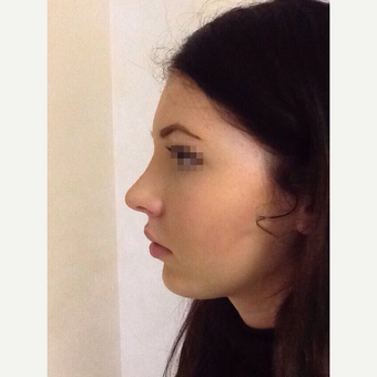 18-24 year old woman treated with Rhinoplasty after 3122791