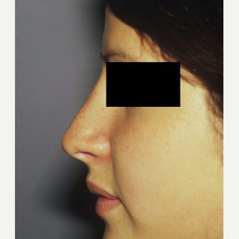 18-24 year old woman treated with Rhinoplasty after 3711540