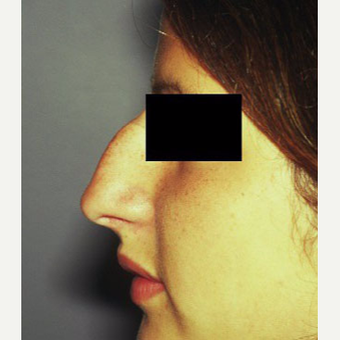 18-24 year old woman treated with Rhinoplasty before 3711540