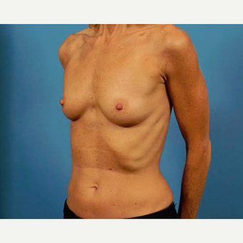 45-54 year old woman treated with Breast Implants before 3786958
