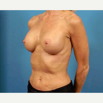 45-54 year old woman treated with Breast Implants after 3786958