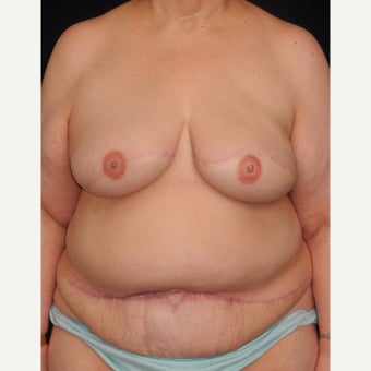 62 y/o - Delayed Bilateral DIEP Breast Flap Reconstruction after 1919814