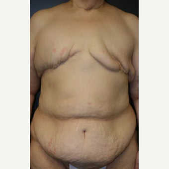 62 y/o - Delayed Bilateral DIEP Breast Flap Reconstruction before 1919814