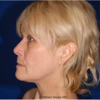 Cheek Augmentation with Natural Fat Transfer before 3104799