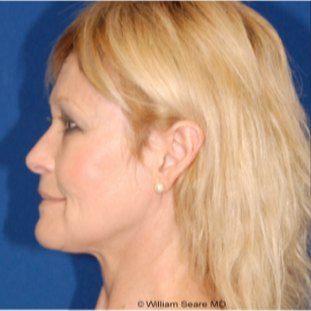 Cheek Augmentation with Natural Fat Transfer after 3104799