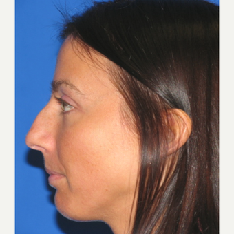 25-34 year old woman treated with Rhinoplasty before 3618891