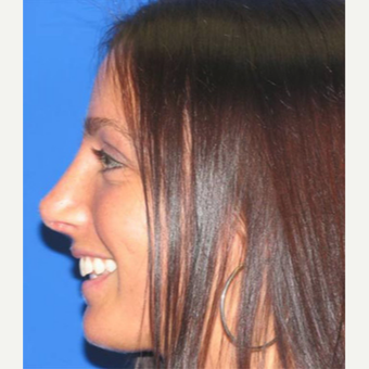25-34 year old woman treated with Rhinoplasty after 3618891