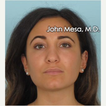 25-34 year old woman treated with Buccal Fat Removal after 3769111