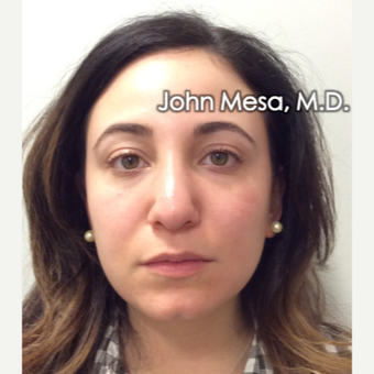 25-34 year old woman treated with Buccal Fat Removal before 3769111