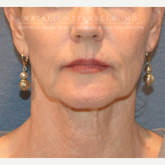Before and After a Facelift before 3613813