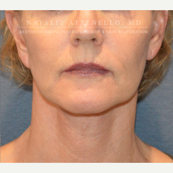 Before and After a Facelift after 3613813