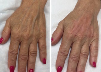 65-74 year old woman treated with Radiesse for a "handlift" before 3191339