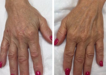 65-74 year old woman treated with Radiesse for a "handlift" after 3191339