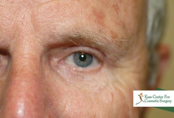Brow lift 366293