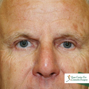 Brow lift after 366293