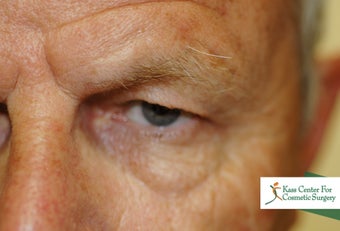 Brow lift 366293