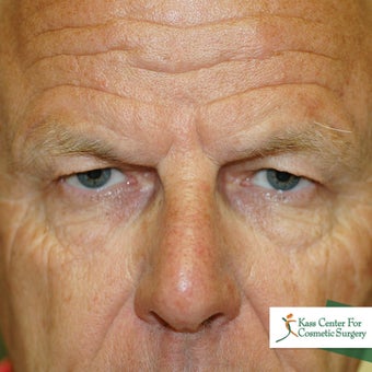 Brow lift before 366293