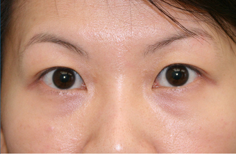 Upper blepharoplasty 507870