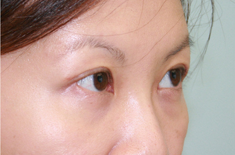 Upper blepharoplasty after 507870