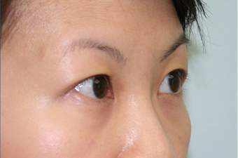 Upper blepharoplasty before 507870