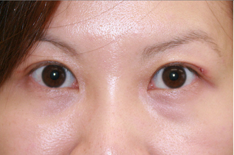 Upper blepharoplasty 507870