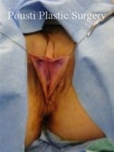 Labial Reduction before 696326
