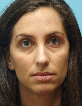 Eye Dermafillers,Cheek Dermafillers,Facial Dermafillers before 333311